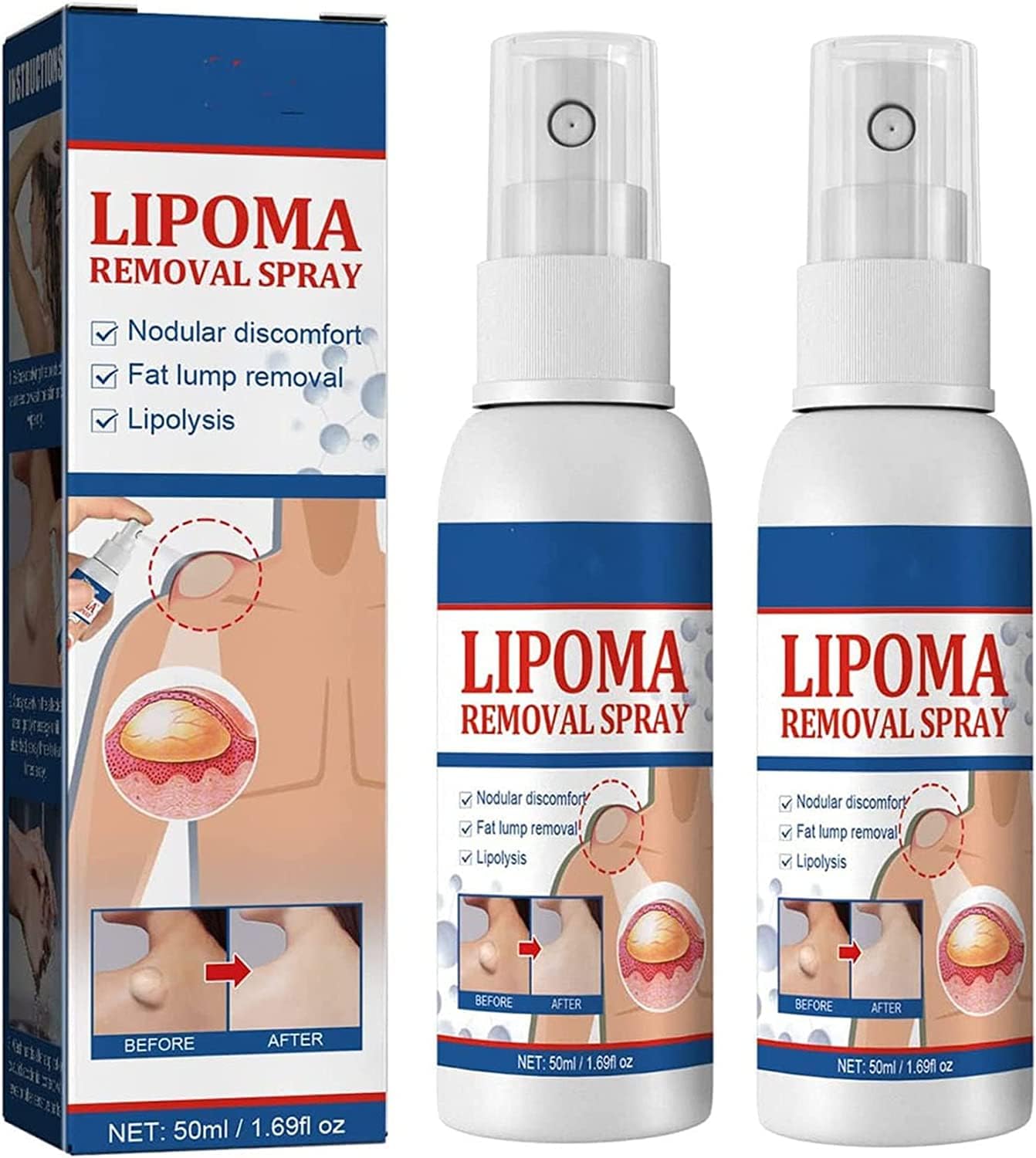 South Moon - Lipoma Removal Spray