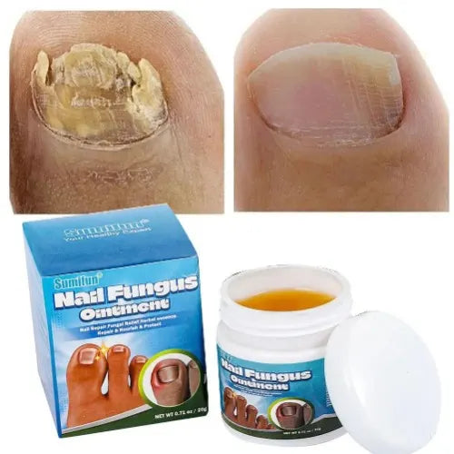 Sumifun - Nail Fungus Ointment