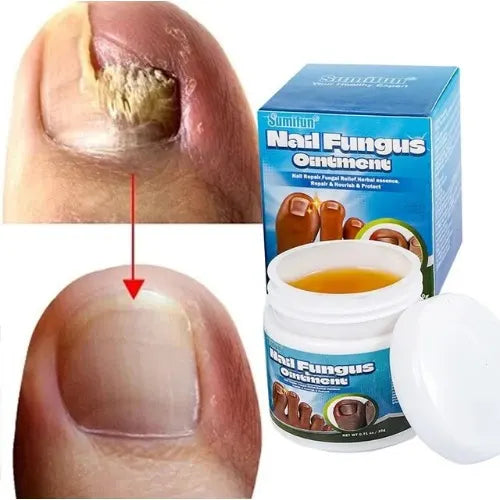 Sumifun - Nail Fungus Ointment